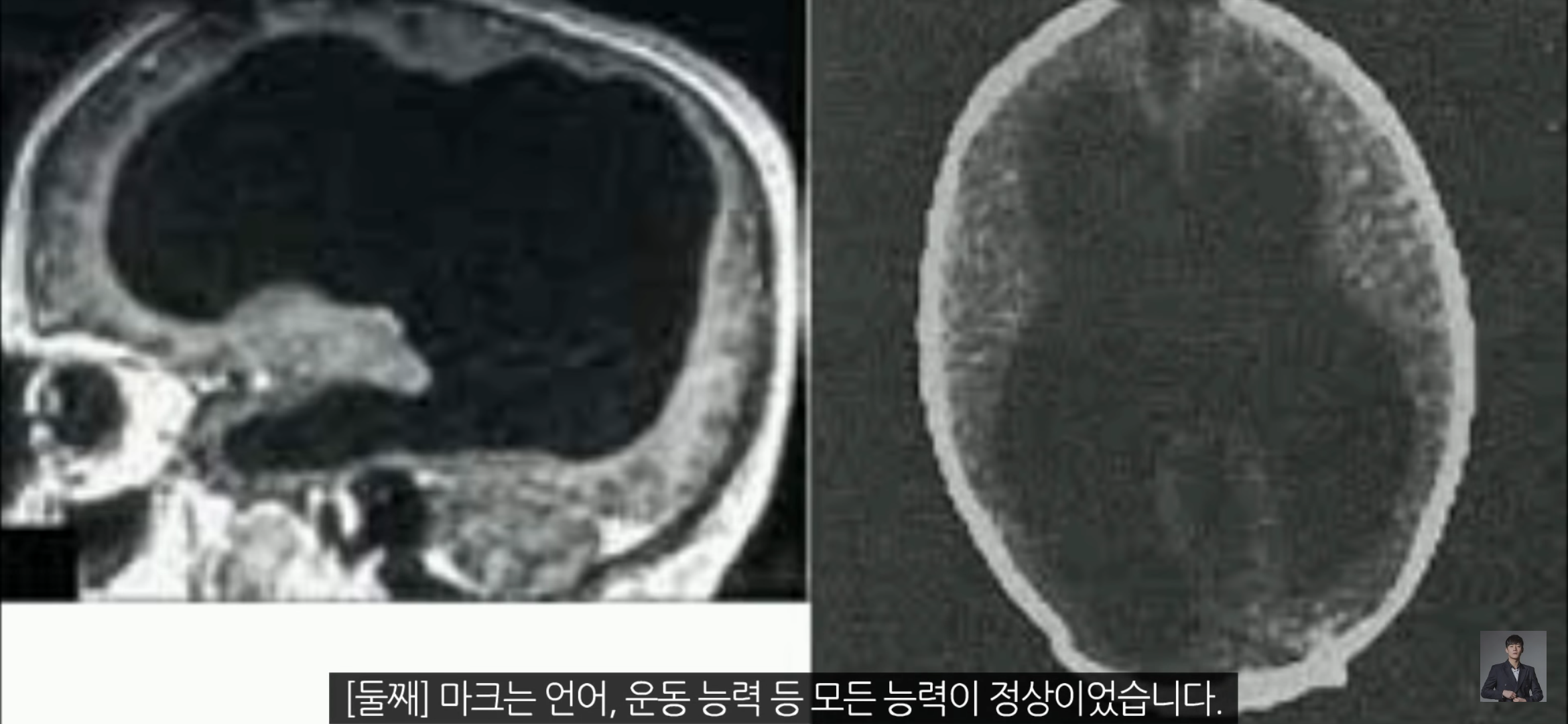 [풀수없는미스테리] 뇌가 없어도 멀쩡한 사람들, 뇌는 필요한 게 맞을까? | 인스티즈