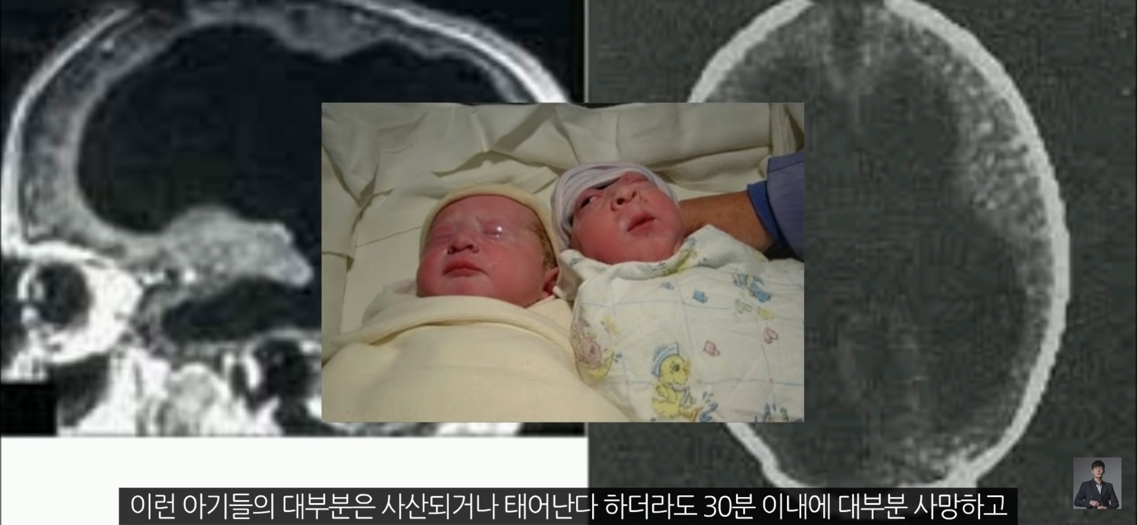 [풀수없는미스테리] 뇌가 없어도 멀쩡한 사람들, 뇌는 필요한 게 맞을까? | 인스티즈