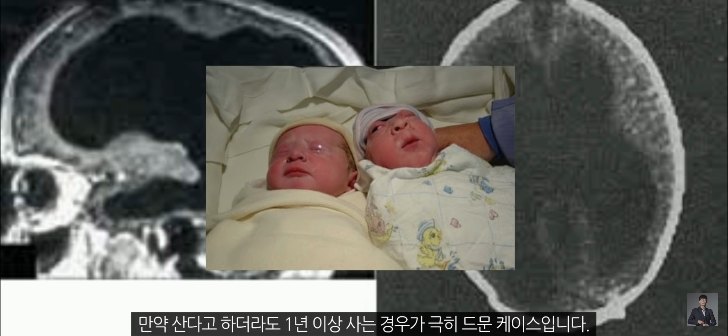 [풀수없는미스테리] 뇌가 없어도 멀쩡한 사람들, 뇌는 필요한 게 맞을까? | 인스티즈