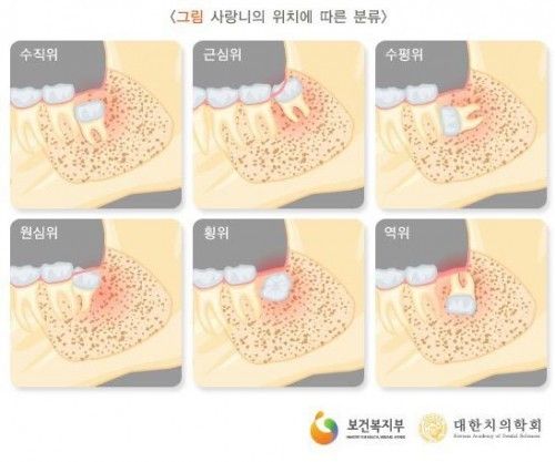 사랑니의 종류.jpg | 인스티즈