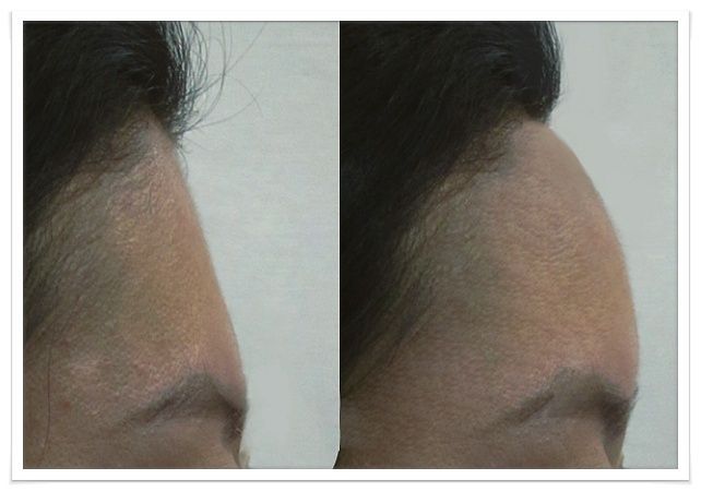 생각보다 많은 여자들이 컴플렉스로 꼽아서 성형 많이 하는 부위 | 인스티즈