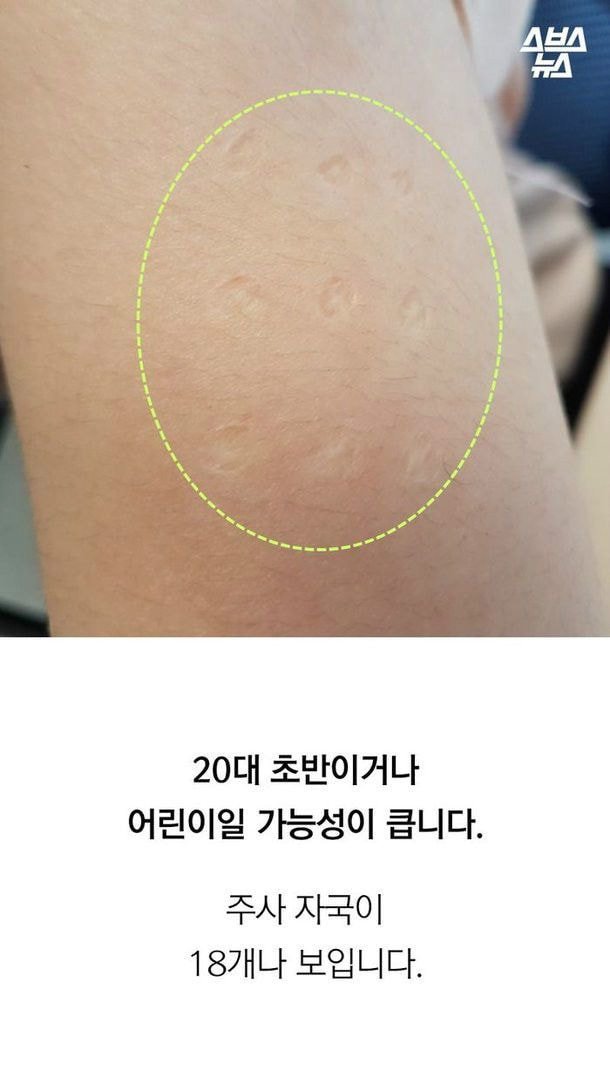 20대 초반 이하만 가지고 있다는 자국 (95년생~2000년생) | 인스티즈