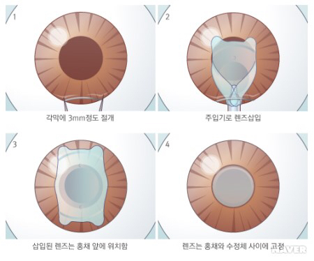 시력 교정 수술중 끝판왕인 렌즈 삽입술 | 인스티즈