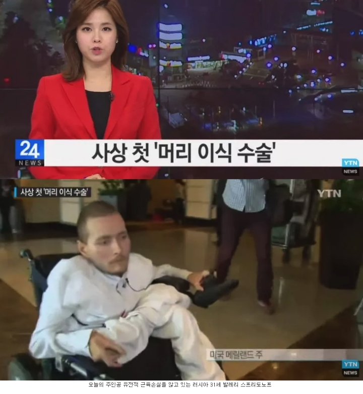 머리 이식 수술...jpg | 인스티즈