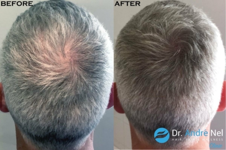 머리숱 없는 사람들이 하고싶어하는 시술.jpg | 인스티즈