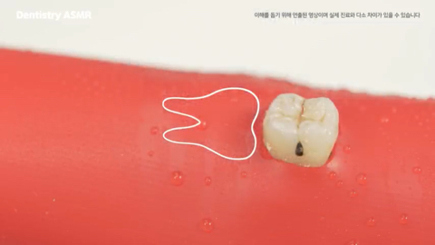 매복 사랑니 발치 ASMR | 인스티즈