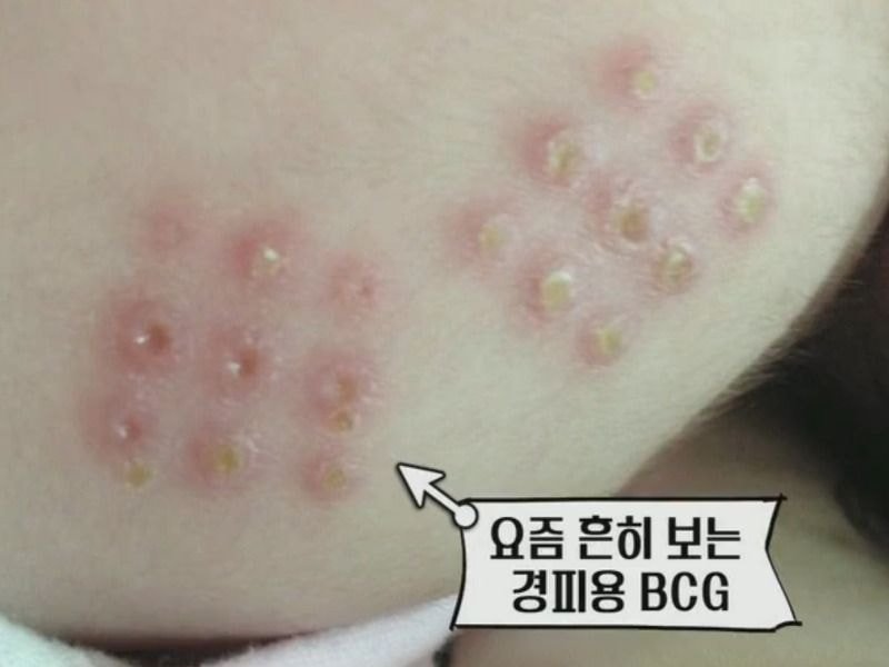 20대 초반 이하만 가지고 있다는 자국 (95년생~2000년생) | 인스티즈