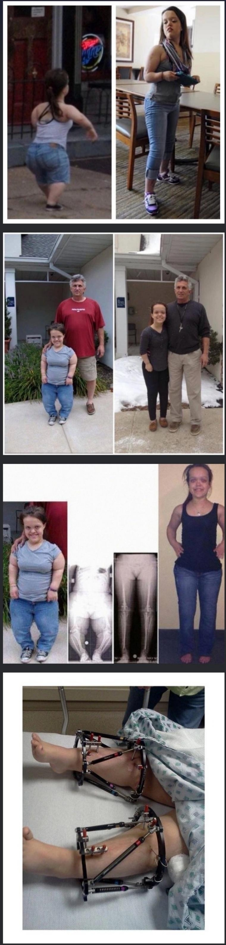 왜소증 교정 수술.jpg | 인스티즈