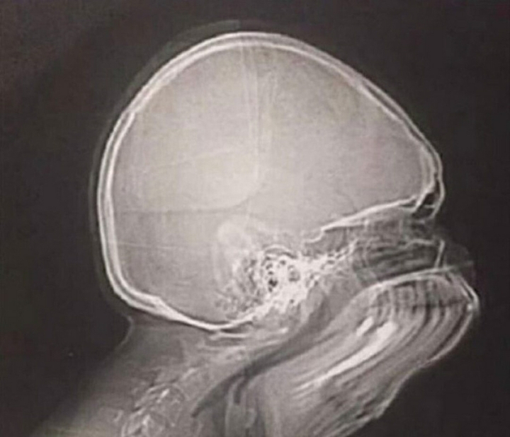 엑스레이찍다가 재채기하면 | 인스티즈