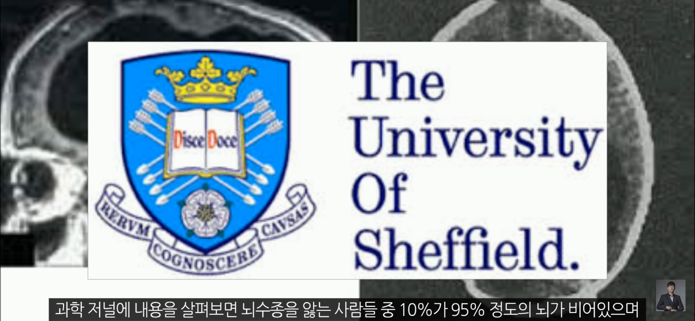 [풀수없는미스테리] 뇌가 없어도 멀쩡한 사람들, 뇌는 필요한 게 맞을까? | 인스티즈