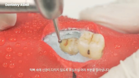매복 사랑니 발치 ASMR | 인스티즈