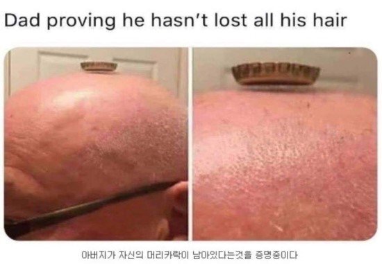 자신이 대머리가 아님을 증명하는 아버지 | 인스티즈