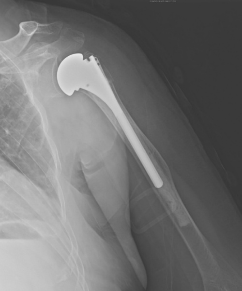 Comminuted Fracture Of Proximal Humerus My XXX Hot Girl