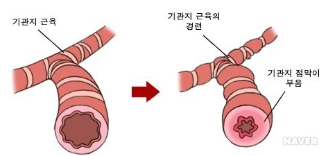 천식 치료 방법 및 원인은 무엇일까?