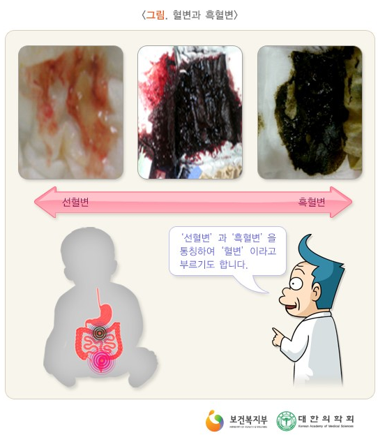 피똥싸는이유, 혈변의 원인은 무엇?