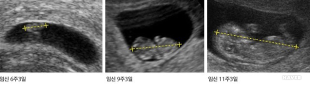 임신초기 아랫배통증, 조심해야할 것