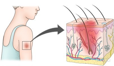 타박상 치료, 무시하면 위험하다