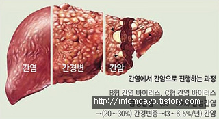 간수치 높을때 증상 그리고 이유는?