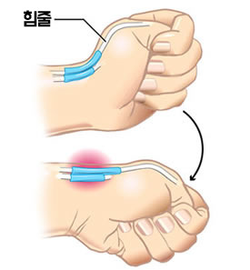 손목이 시큰 시큰 아플때 : 손목건초염 의심 통증 증상 치료 방법