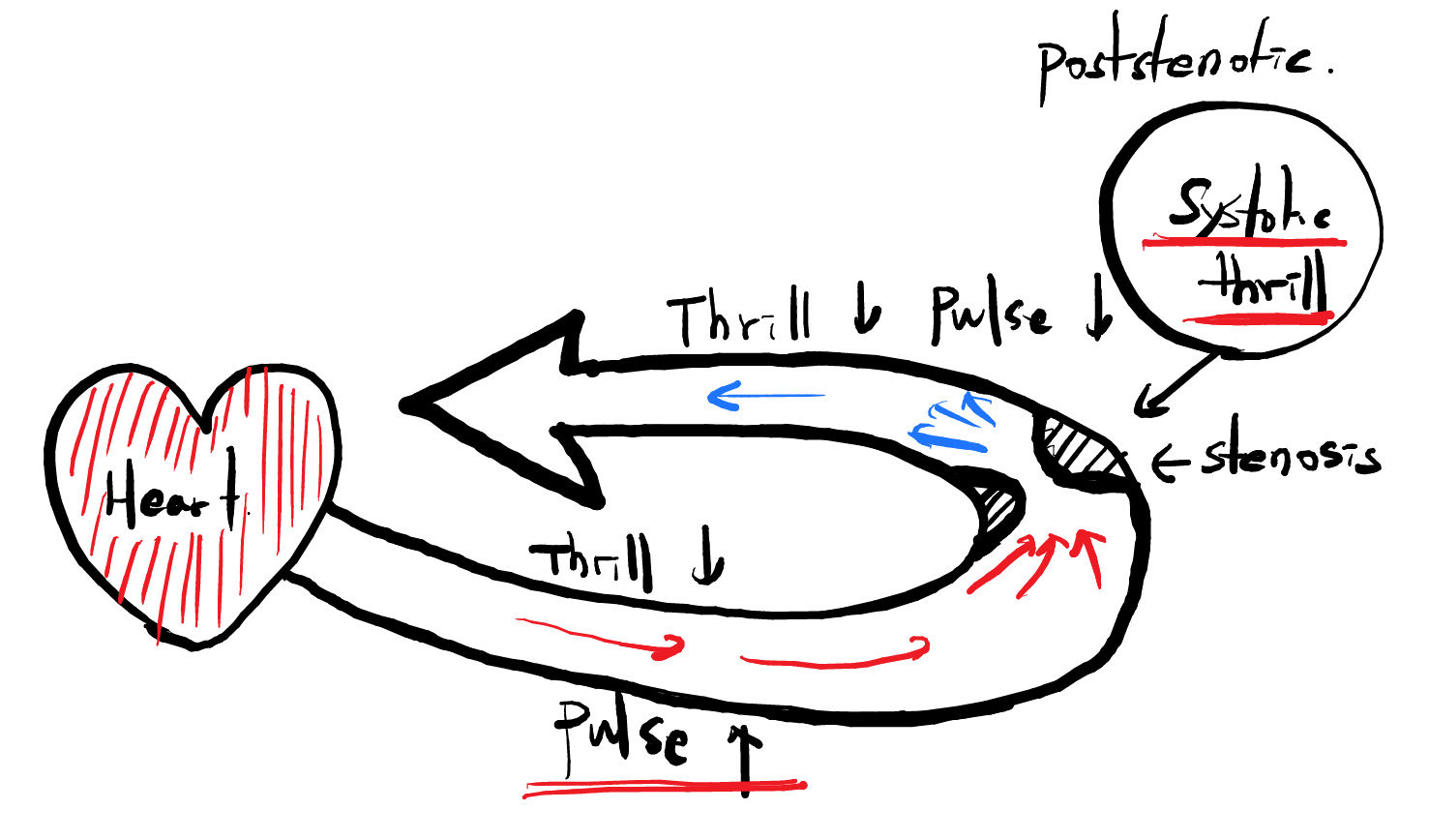 AVF stenosis physical examination 에 대한 기본 원리