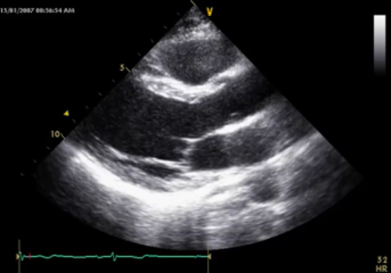 [MC] 심낭 질환 : Pericardial Effusion, Cardiac tamponade