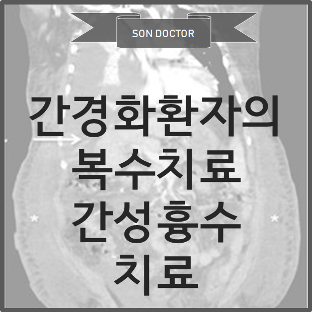 간경화 환자의 복수의 치료, 간성 흉수의 치료