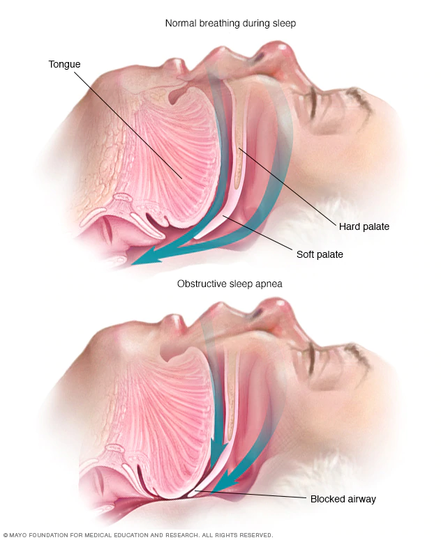 수면 무호흡증 증상, 원인, 치료 Sleep apnea - Symptoms and causes