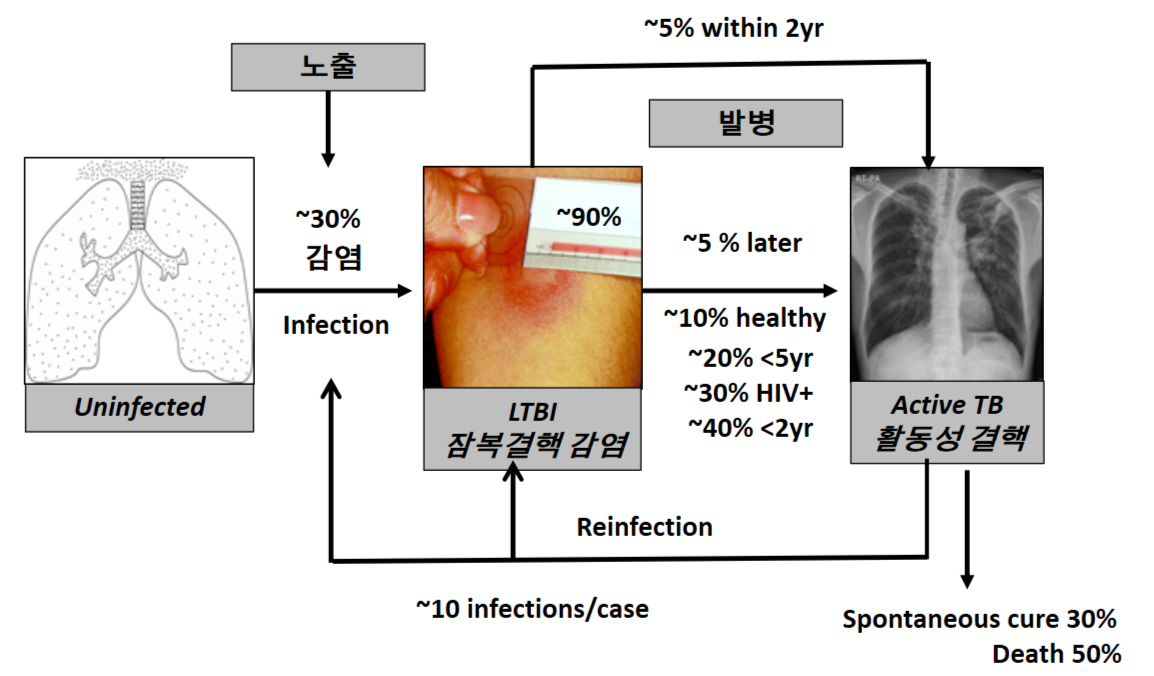 잠복결핵의 진단 및 치료
