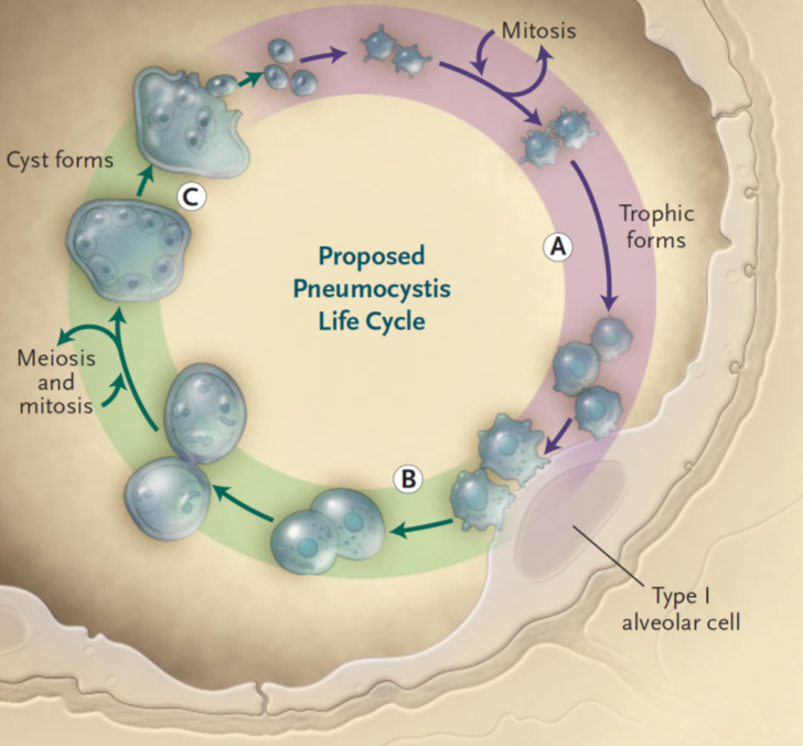 Pneumocystis pneumonia (폐포자충 폐렴)