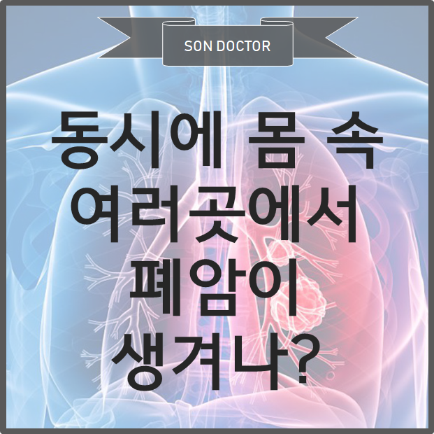Synchronous Multiple Primary Lung Cancer (동시에 여러 곳에서 폐암이 생겨나?)