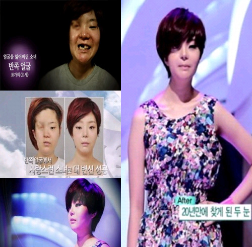렛미인피부 이미지