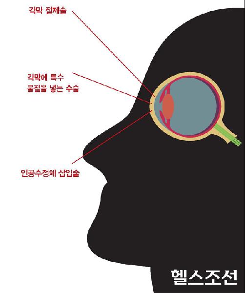 [헬스조선]노안 교정법 (사진 셔터스톡)
