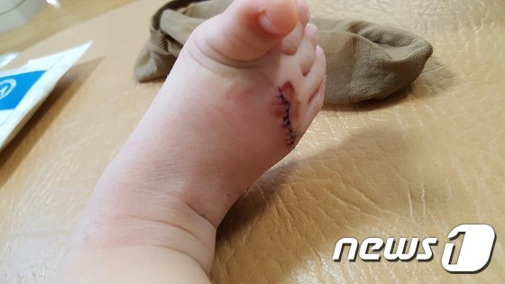 회사로고가 면도날?..1세 여야 발 등 베여 8바늘 꿰메 - 뉴스1