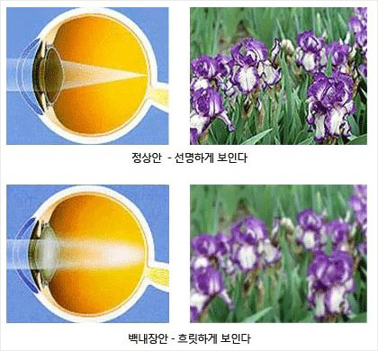 백내장 증상 (사진=김안과병원 제공)