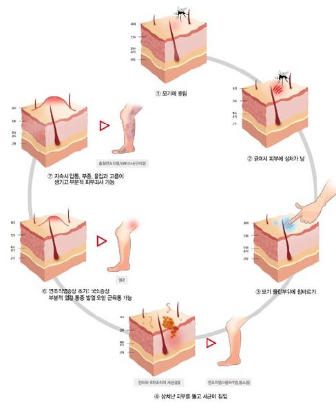 [헬스조선]모기 물린 부위를 긁은 뒤 침을 바르면 봉와직염이 생길 수 있다/사진= 아름다운나라피부과