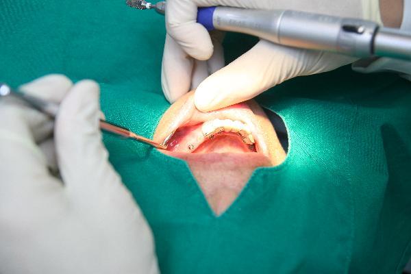 [헬스조선]고령자는 잇몸 뼈가 파괴되거나, 만성질환을 겪고 있는 경우가 많아 임플란트 전 자신의 상태를 꼼꼼히 파악한 뒤 시술을 받아야 한다/사진=헬스조선 DB