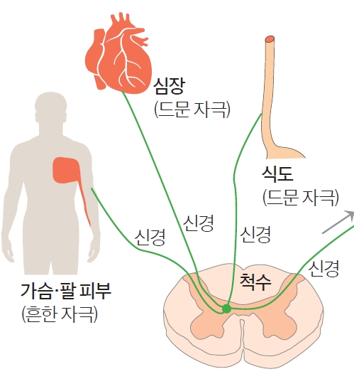 심장, 식도, 가슴과 팔 안쪽 피부는 척수에서 하나의 신경으로 모여 뇌에 전달된다. 뇌는 가장 익숙한 피부의 통증을 먼저 인식한다.