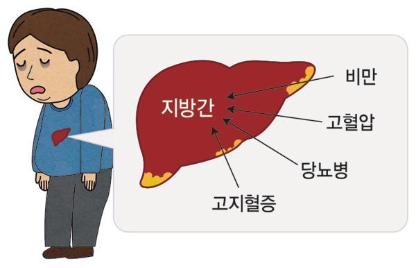 [헬스조선]비알코올성 지방간 환자는 최근 5년 사이 115% 증가했다/사진출처=강동경희대병원 제공