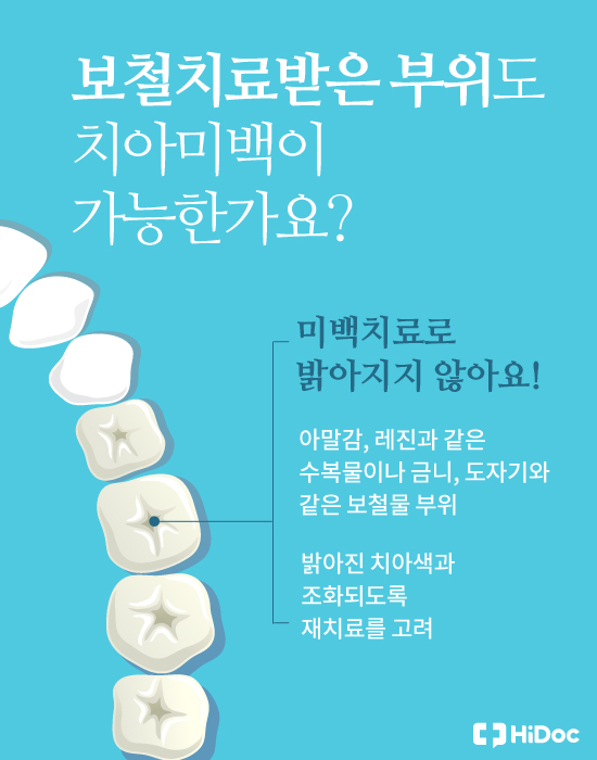 이가 더 하얘질까? ‘치아미백’ 궁금증 5가지