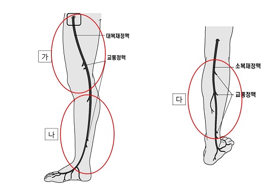 하지정맥류