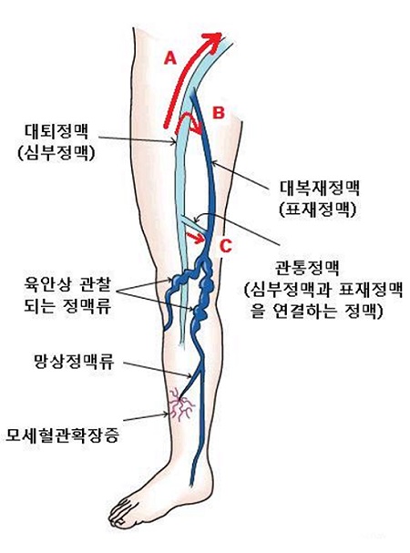 하지정맥류