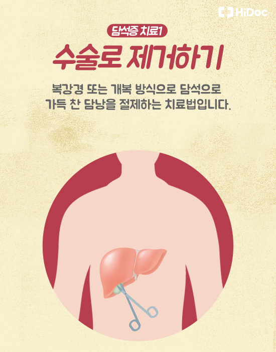 담석증 치료 1. 수술로 제거하기