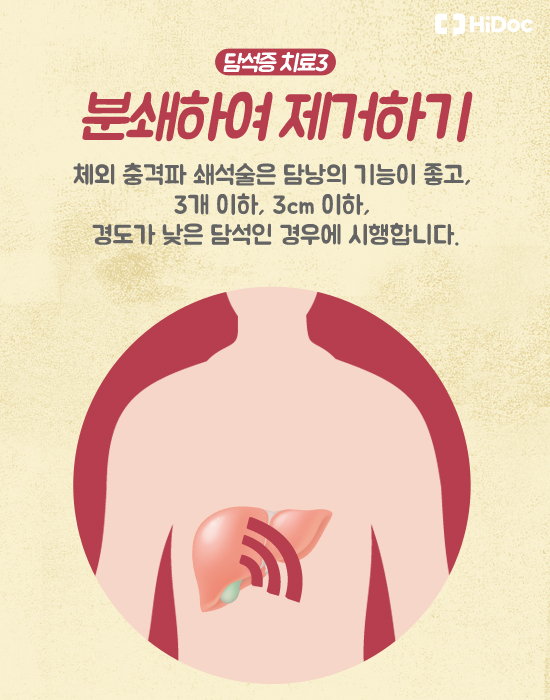 담석증 치료 3. 분쇄하여 제거하기