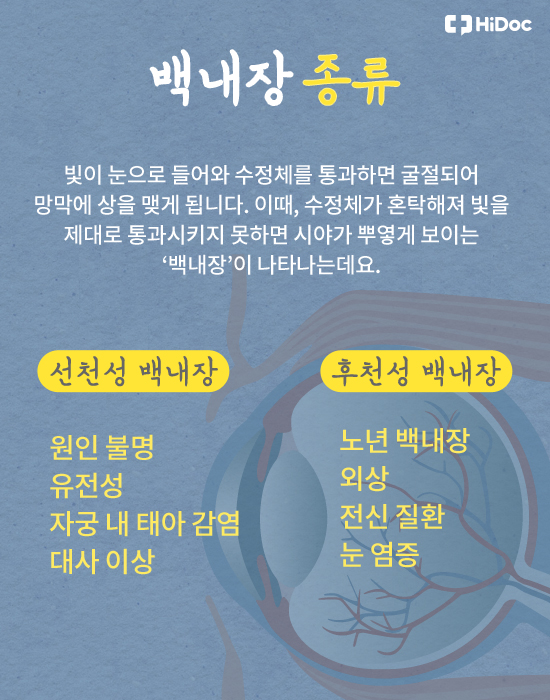 당신의 눈 건강한가요? 백내장 주요 증상