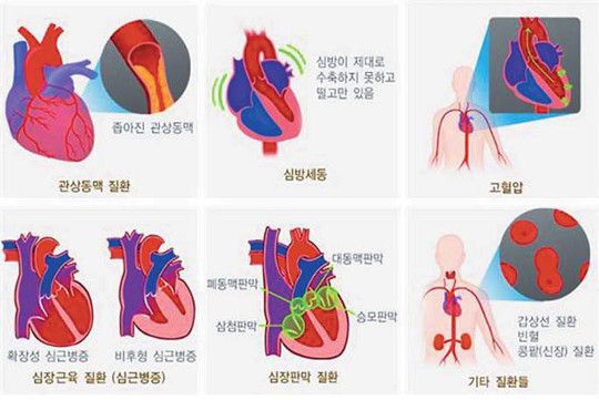 심부전은 한 번 진단 받으면 응급실을 통해 입원하는 경우가 많고 퇴원하더라도 입원을 다시 하는 악순환을 반복하기 때문에 진단을 받고 적극적으로 관리하는 것이 무엇보다 중요하다.
