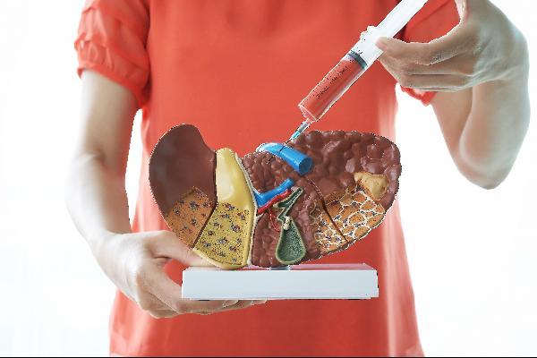 [health chosun]지방간은 간암으로까지 악화될 수 있어 평소 체중을 조절하고 당뇨병, 고혈압 등 지방간을 유발할 수 있는 만성질환 예방에 힘써야 한다/사진=헬스조선 DB