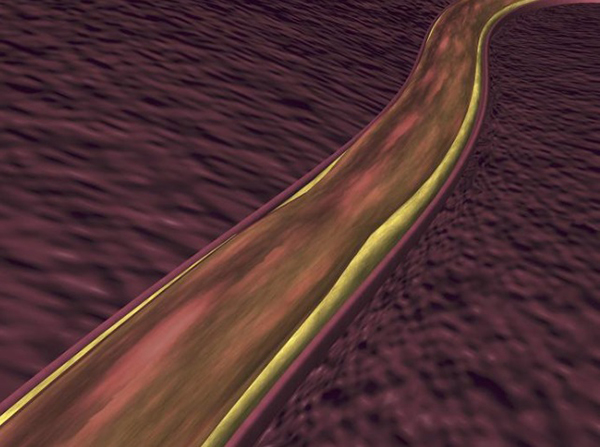 혈전증은 평소 증상이 없어도 갑자기 혈관을 막아 급사에 이를만큼 치명적이다. /사진=헬스조선DB