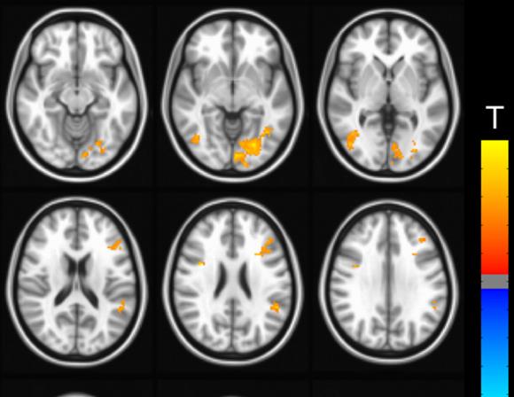 노란색이 치료 후 뚜렷한 뇌기능 향상을 보인 부위. 윗줄이 뇌의 앞쪽인 전두엽, 아래 줄이 뇌의 측면인 두정엽 부위다./사진=서울대병원