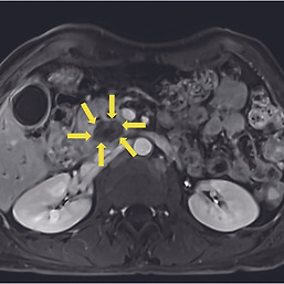 췌장 관선암의 MRI 소견