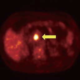 PET 검사에서 관찰되는 췌장의 종양